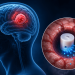¿Puede un implante cerebral cambiar el tratamiento del glioblastoma?